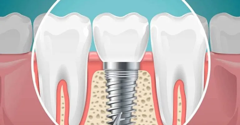 One Day Implant