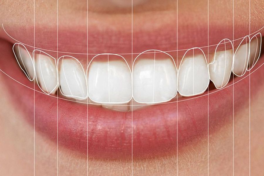 Smile Design